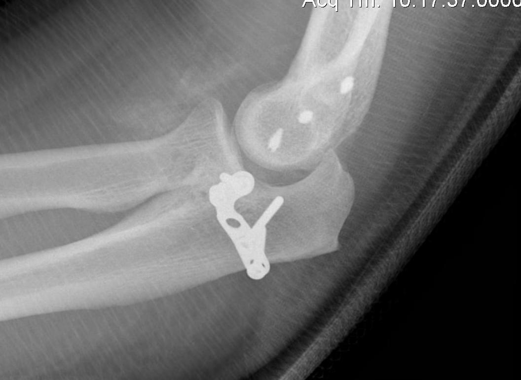 Coronoid Process Buttress Plate